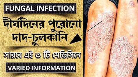 Fungal Infection Complete Treatmentfungal Infection Treatmentfungal
