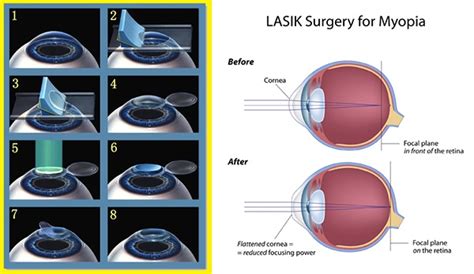 What Not To Do After Laser Eye Surgery