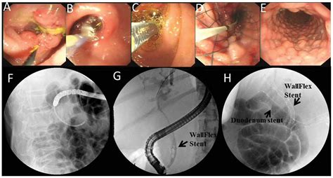 Retrospective Evaluation Of Endoscopic Stenting Of Combined Malignant