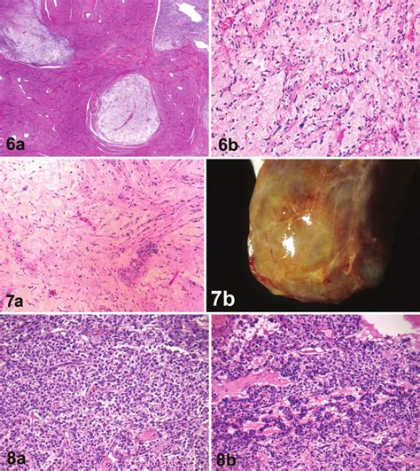Myxoid Leiomyosarcoma A The Tumor Has An Infiltrative Growth Pattern