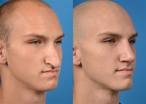 Male Plastic Surgery And Before And After