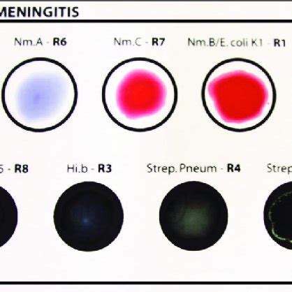 Diagnosis Of Neonatal Bacterial Meningitis Using Cerebrospinal Fluid Download Scientific