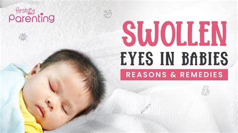Swollen Eyes In Babies Causes And Remedies Youtube