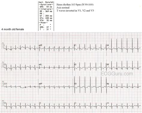 Introduction To Pediatric Ecg