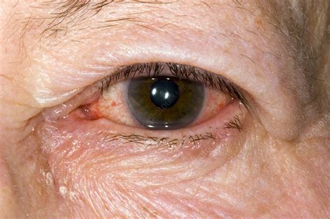 Allergic Conjunctivitis Stock Image M1550570 Science Photo Library