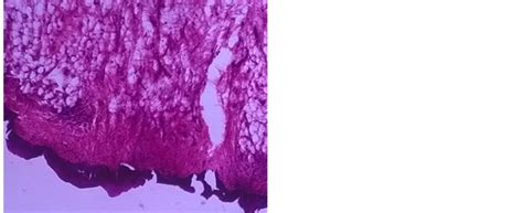 A Pedunculated Fibrolipomatous Polyp Of Tonsil A Rare Case Report