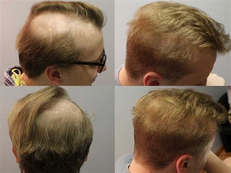 Hair Loss After Surgery How To Grow Your Hair Back Lewigs