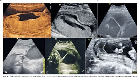 Figure 1 From Abnormal Ultrasound Appearance Of The Amniotic Membranes