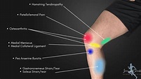 Knee Pain Location Chart | Learn the Pain Location of Knee Injuries