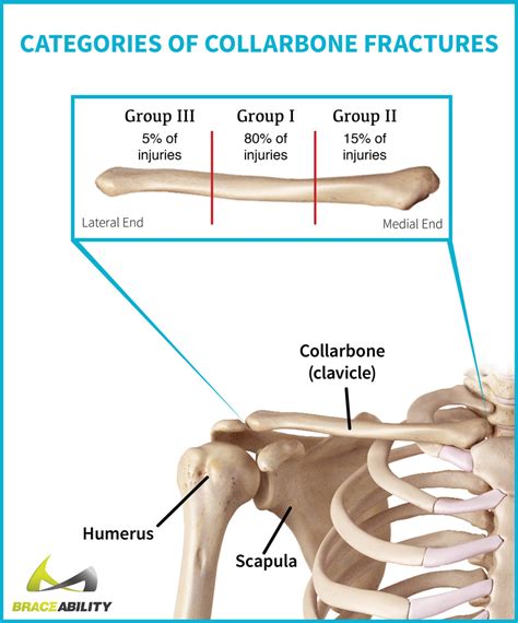 Clavicle Fractures Broken Collarbone Symptoms Causes And Treatment