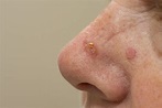 Basal Cell Carcinoma | Skin Cancer Clinic Perth