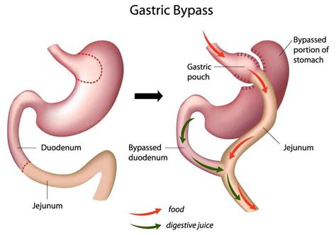 What Is Gastric Bypass Surgery Meaning And Different Types