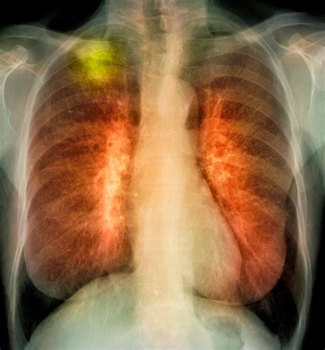Cuba Has A Lung Cancer Vaccine—and America Wants It Wired