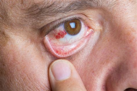 Scleritis Inflammation Of The Sclera