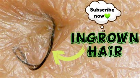 Ingrown Hair Removal On The Groininguinal Short Video Youtube