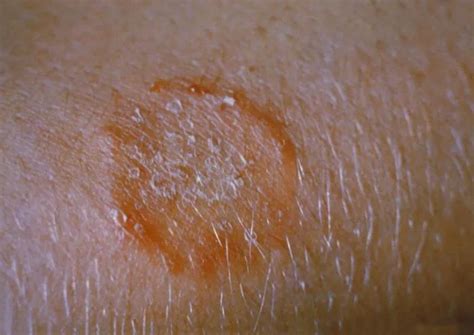 Facts About Tinea Corporis Infection Dovemed