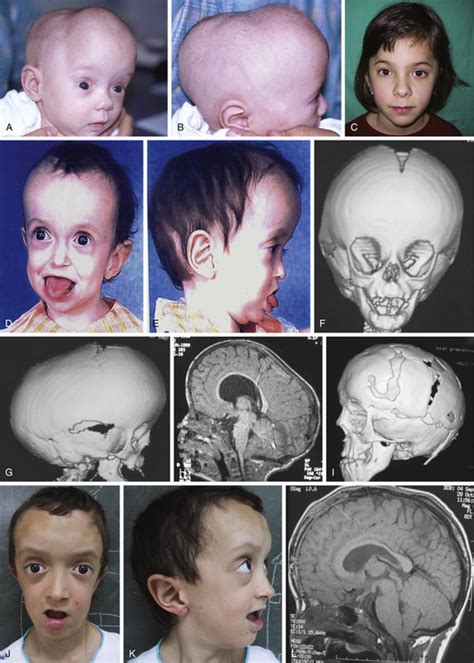 Methods Of Cranial Vault Reconstruction For Craniosynostosis Clinical