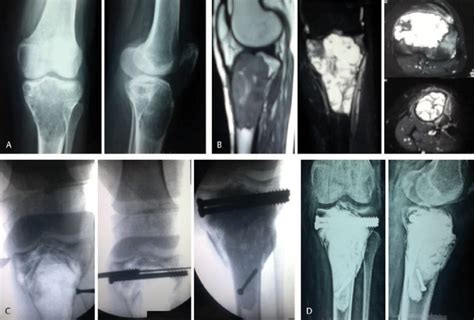 Giant Cell Tumor Of Proximal Tibia A Radiographs Showing Lytic