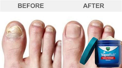 How To Treat Toenail Fungus With Vicks Healthy Lifestyle