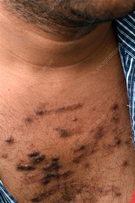 Keloid Scarring Stock Image C0372226 Science Photo Library