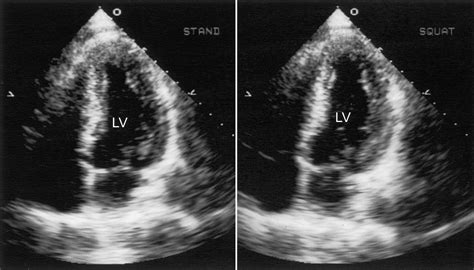 Left Ventricular Wall Motion Abnormalities Induced By Squatting A New