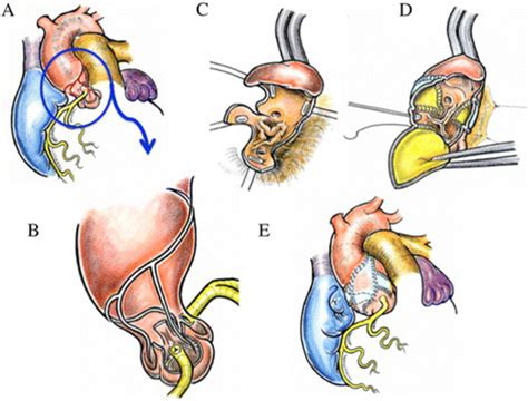 Schematic Diagram Of The Surgical Technique A The Illustration Shows