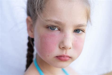 Facial Swelling Allergy Stock Photos Free And Royalty Free Stock Photos