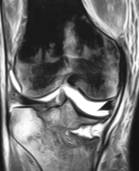 Magnetic Resonance Imaging Mri Of The Right Knee Before The