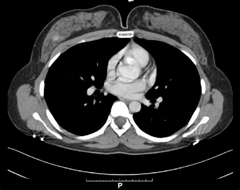E Axial Postcontrast Ct Of The Chest In Two Contrast Windows