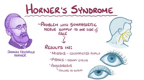 Horner S Syndrome Mnemonic My Xxx Hot Girl