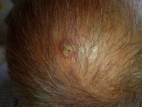 This Lesion On The Scalp Has Been Growing For The Past 4 Weeks In The