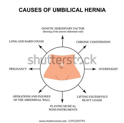 Causes Umbilical Hernia Infographics Vector Illustration Stock Vector