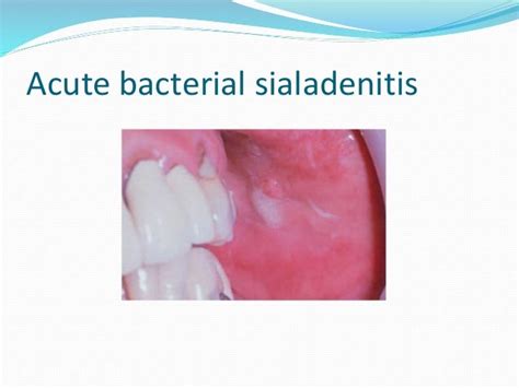 Bacterial Sialadenitis Pdf