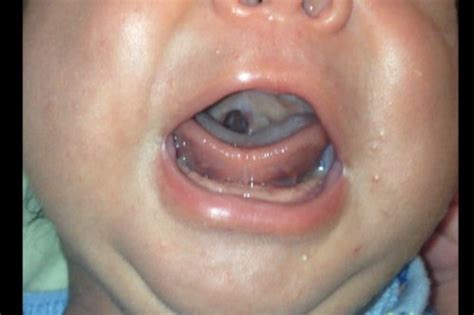 Picture Of Soft Cleft Palate Babycenter