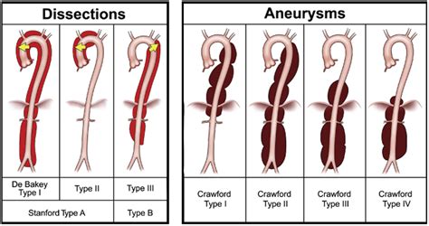 Thoracic Aortic Aneurysm Classification Google Search Aorta Abdominal