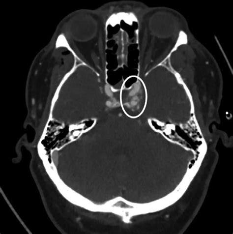 Axial Contrast Enhanced Ct Image Demonstrating Asymmetric Opacity Of