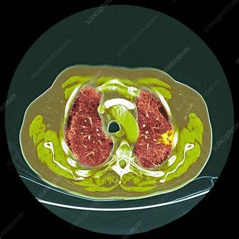 Lung Cancer Ct Scan Stock Image F Science Photo Library