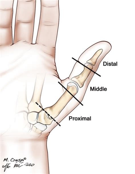 Management Of Soft Tissue Defects Of The Thumb