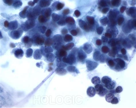 Small Cell Carcinoma Respiratory Cytology