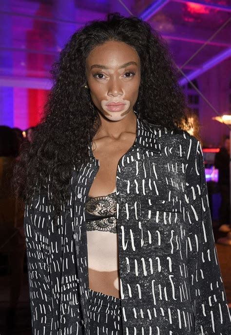 Pin On Vitiligo Beauty