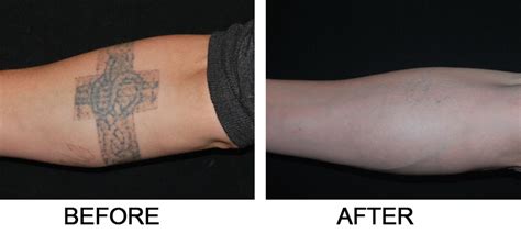Keep in mind that most temporary tattoos are able to stand up to water and soap, so oil is generally the best way to go if you want to scrub a temporary tattoo off. Laser Tattoo Removal | Salmon Creek Plastic Surgery