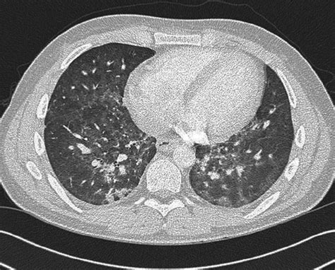 Pneumocystis Jiroveci Pneumonia And Pneumomediastinum In