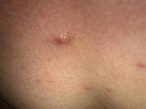 What Is This On My Chest Cyst Backbodyneck Acne