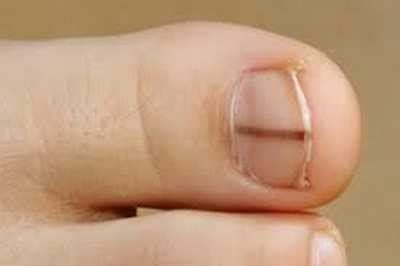 Black Line On Nail Causes Diagnosis Treatment When To See A Doctor