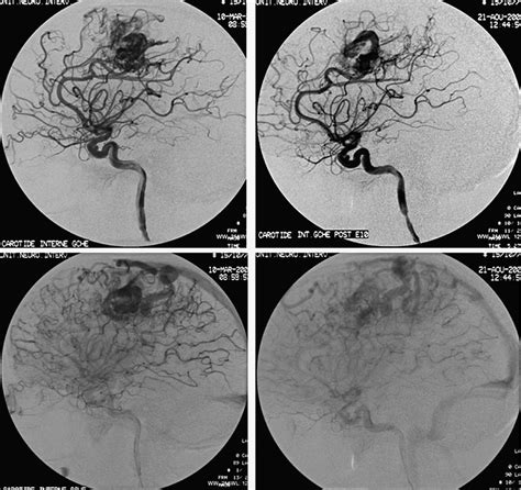 Cerebral Angiography Before A And After B Embolization Showing A