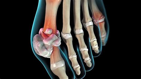 Data Now Out For Pegloticase Mtx Combo Gout Treatment Medpage Today