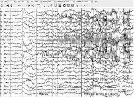 The Eeg In Status Epilepticus Neupsy Key