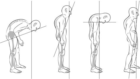 Ankylosing Spondylitis Posterior Approaches Osteotomy To The