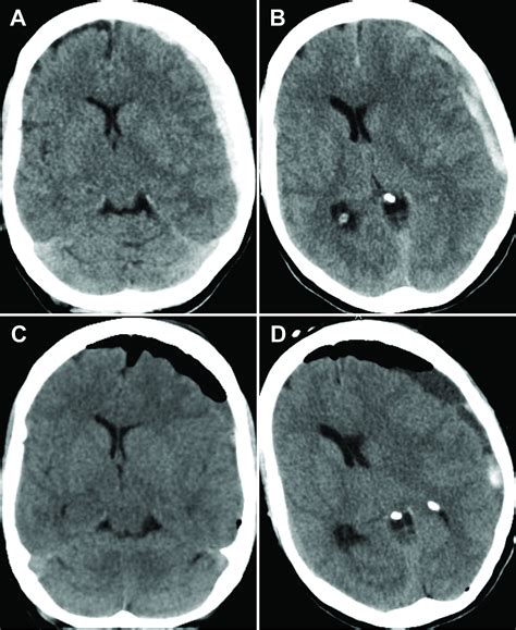 Cureus Intracranial Vasospasm After Evacuation Of Acute Spontaneous