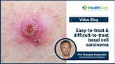 Easy-to-treat & difficult-to-treat basal cell carcinoma